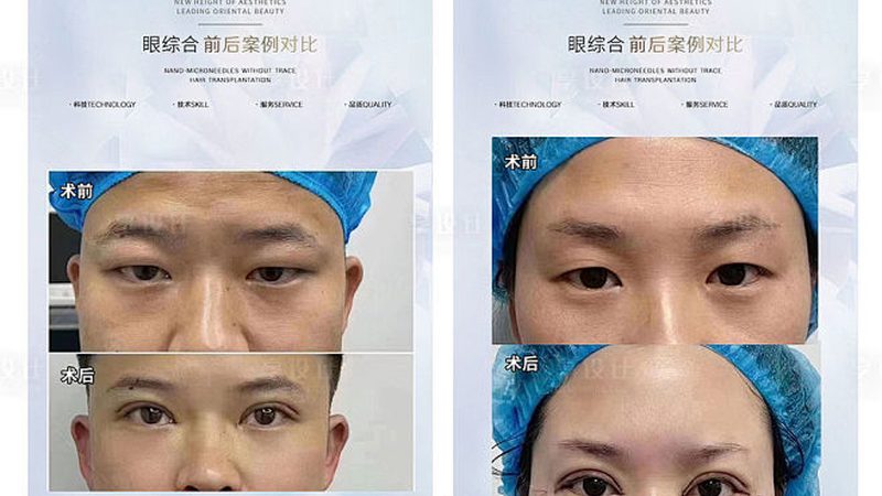 肉毒素品牌如何甄别？揭秘选择标准与误区**