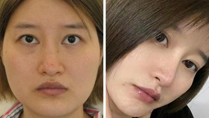 医美面膜与普通面膜：揭秘两者差异，选择更明智
