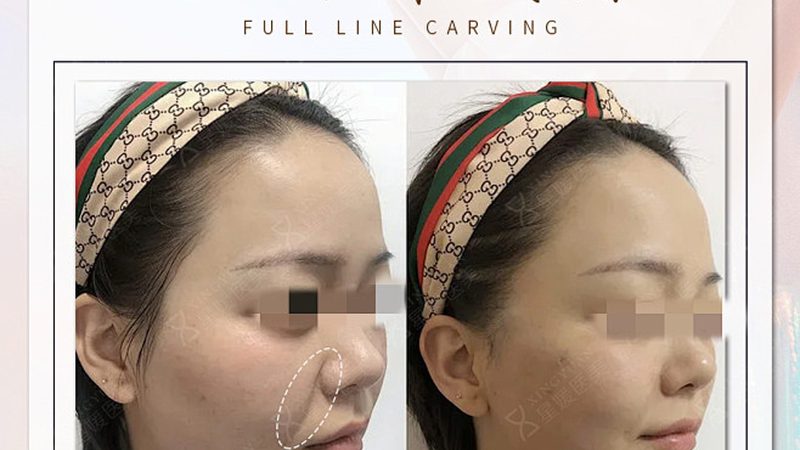 超声炮：揭秘其工作原理与价格构成
