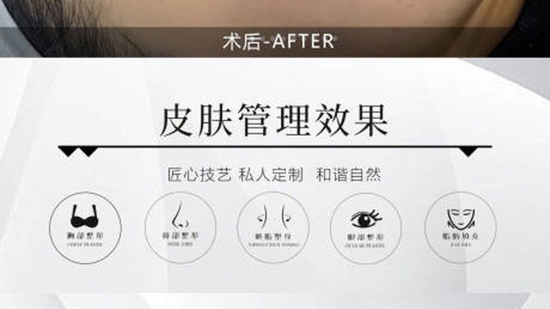IPL激光祛斑仪加盟代理：揭秘技术原理与市场趋势