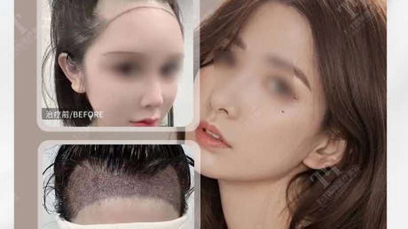 埋线双眼皮：揭秘其技术原理与选择要点