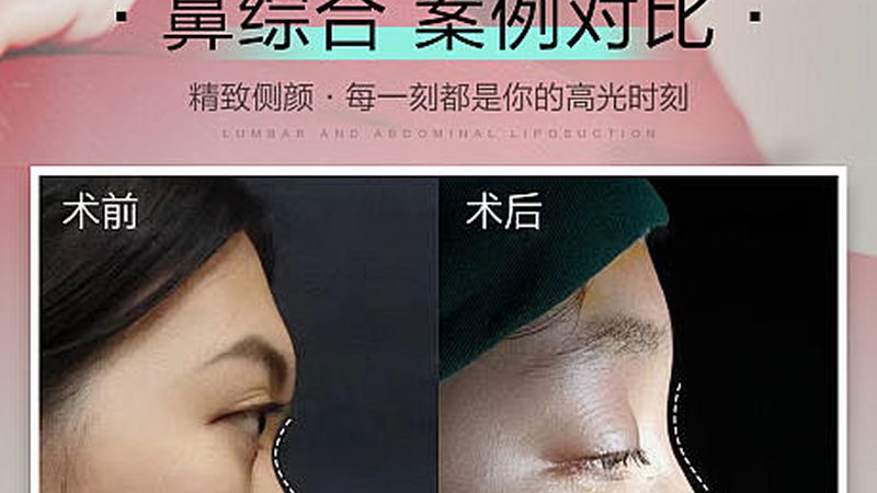 国产轻医美仪器：揭秘其崛起背后的技术魅力