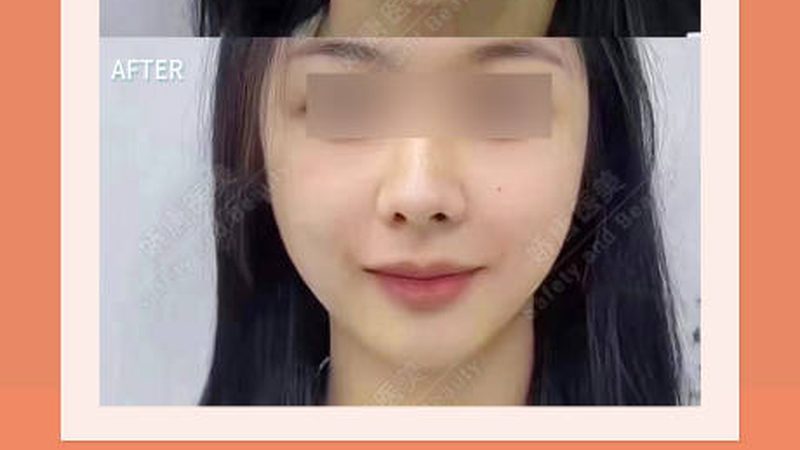 成都注射美容，揭秘见效次数之谜