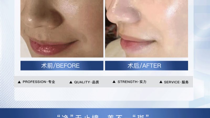 激光祛斑，美丽无痕——2025重庆激光祛斑技术解析