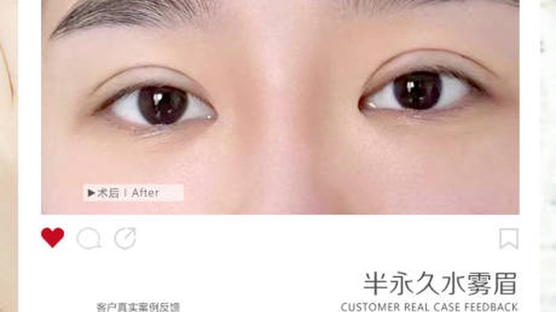 肉毒素治疗斜视：非手术方法与手术治疗的区别解析