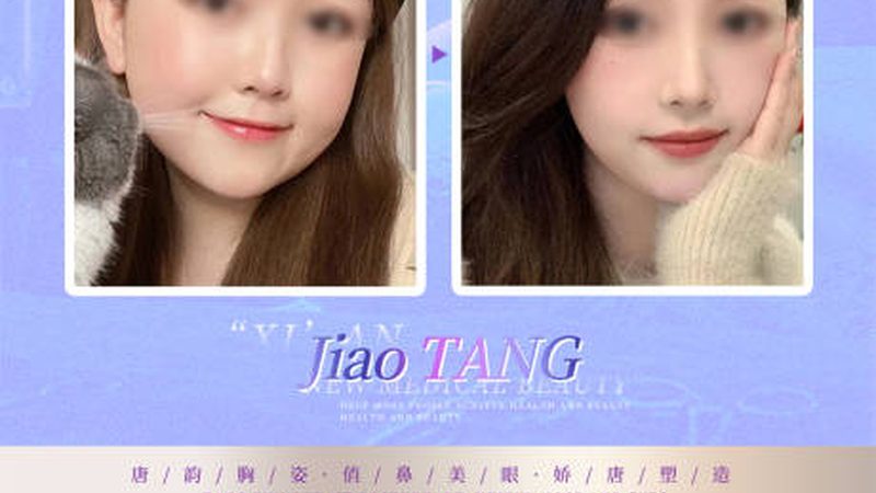 玻尿酸与肉毒素联合注射：揭秘联合注射的精准施术步骤