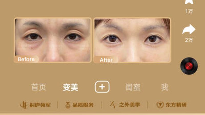 肉毒素治疗斜视后遗症：原理与效果解析