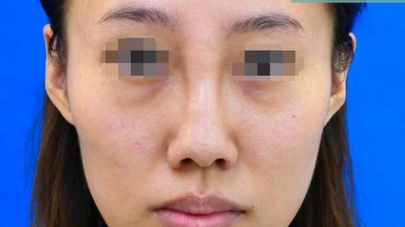 蛋白线面部提升，揭秘其神秘步骤
